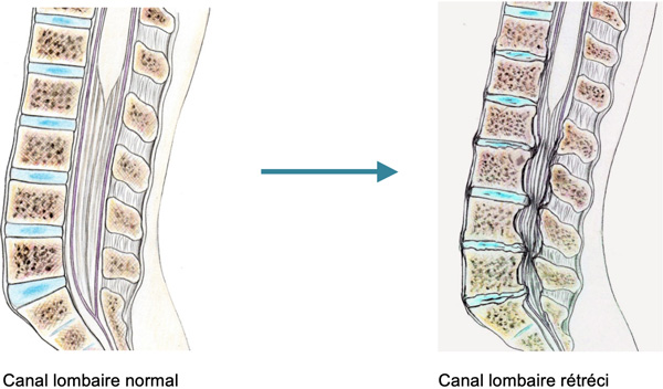canal lombaire étroit
