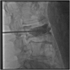 cimentoplastie fracture rachis