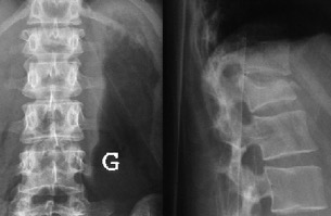 fracture vertebre