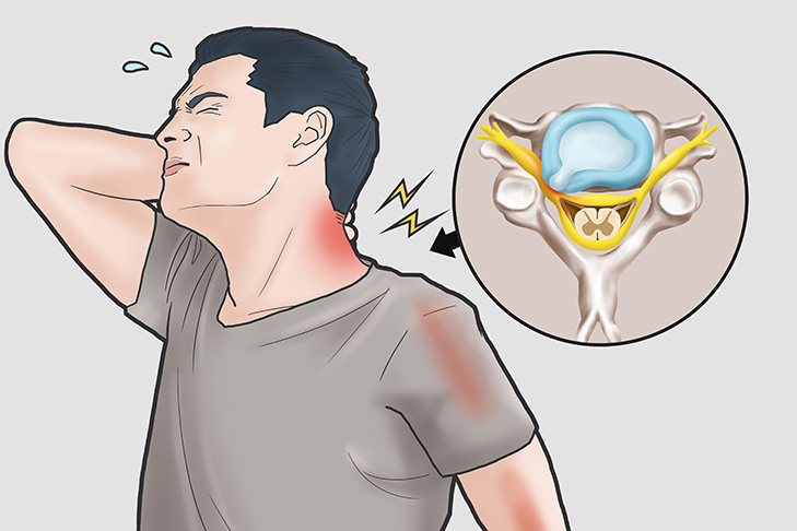 hernie discale cervical