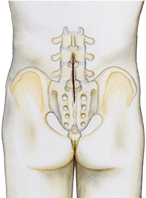 incision posterieur