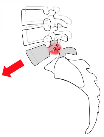 spondylisthesis