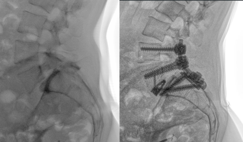 spondylisthesis