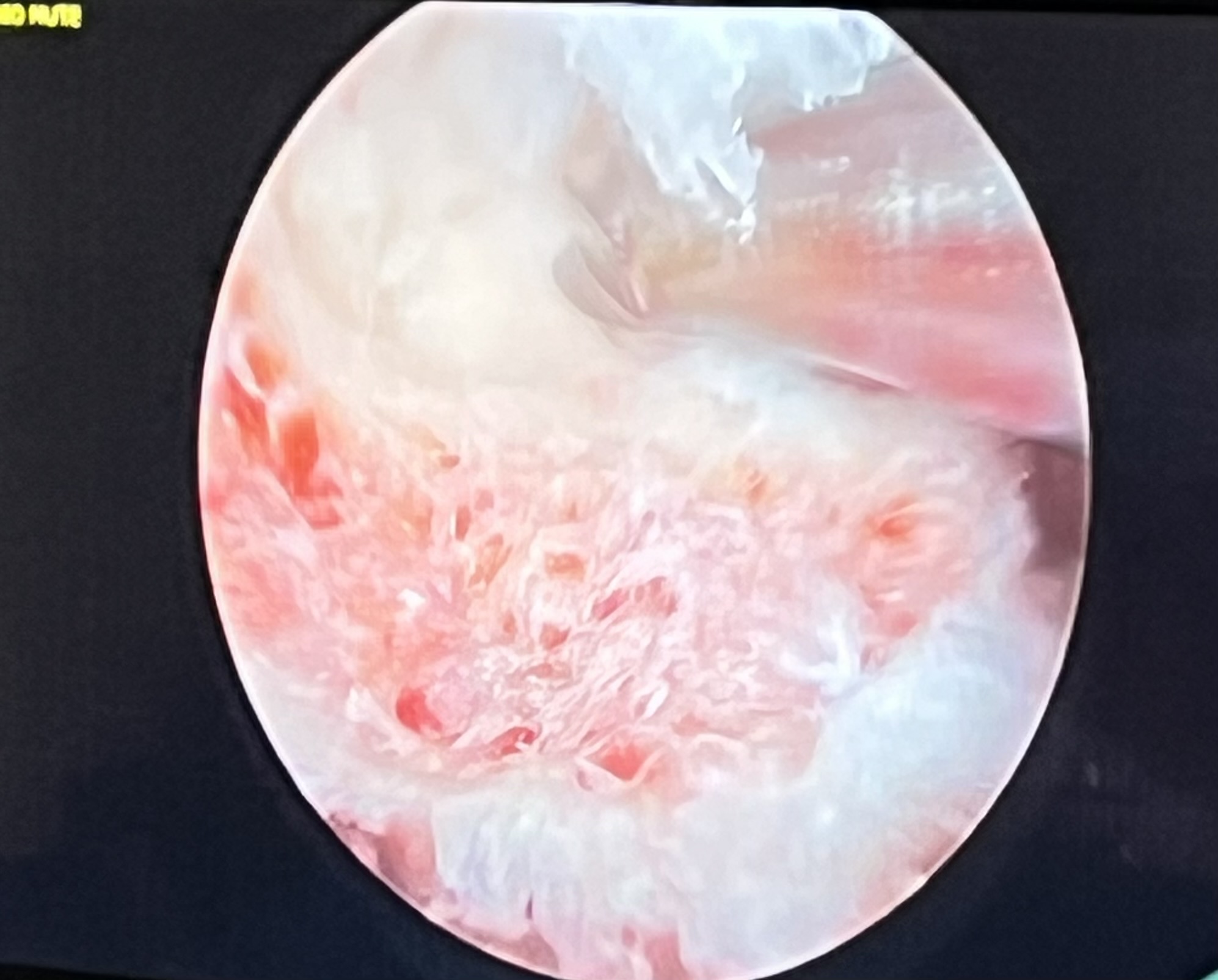 endoscopie hernie rachis lyon