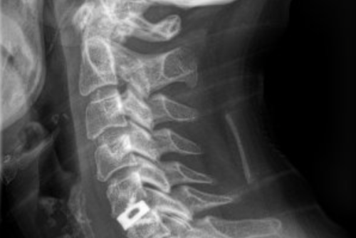 arthrose cervicale lyon
